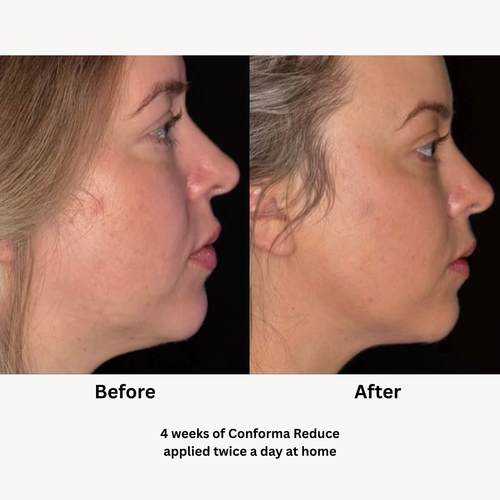 Load image 1 in gallery view. Conforma Reduce