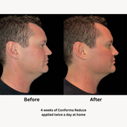 Man in black shirt shown in profile before and after 4 weeks of twice-daily Conforma Reduce use, with the after image showing reduced under-chin fat and fullness with a more defined jawline.
