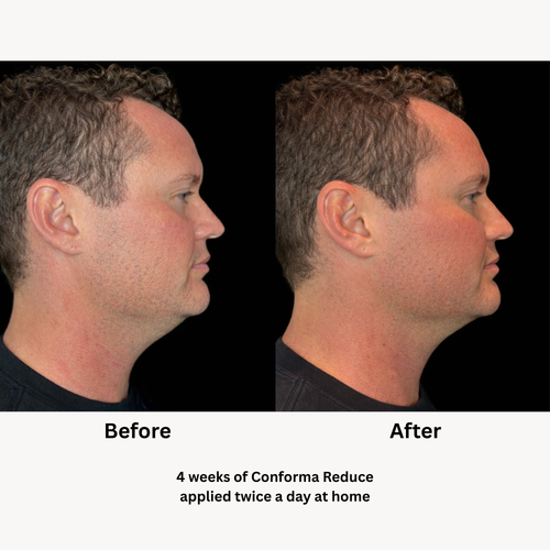 Load image 1 in gallery view. Conforma Reduce