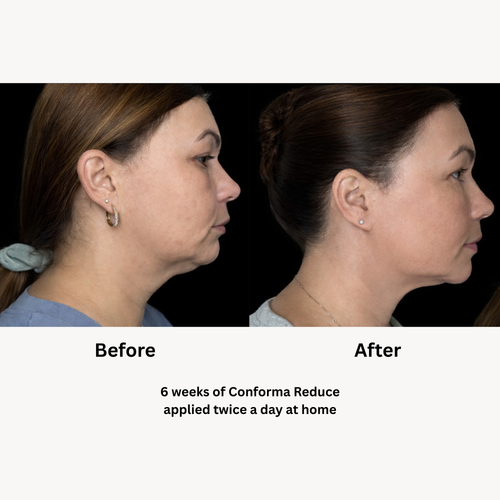 Load image 1 in gallery view. Conforma Reduce