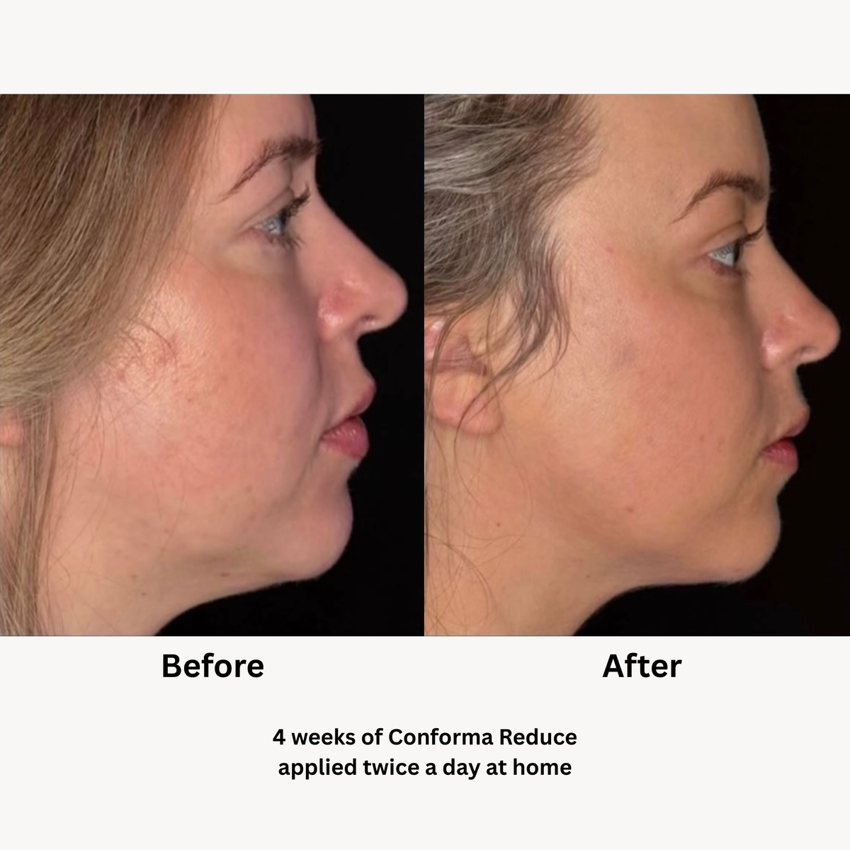 Woman shown in profile before and after 4 weeks of twice-daily Conforma Reduce use, with the after image showing reduced under-chin fat and fullness and a more defined jawline.
