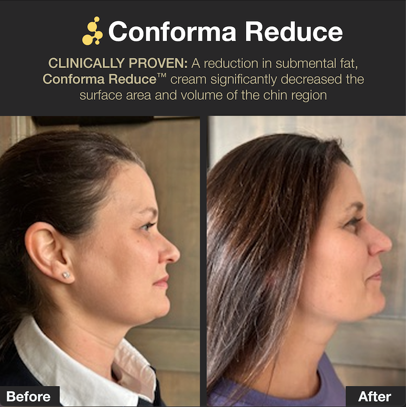 Conform Reduce™ Buy 2 Get 1 Free