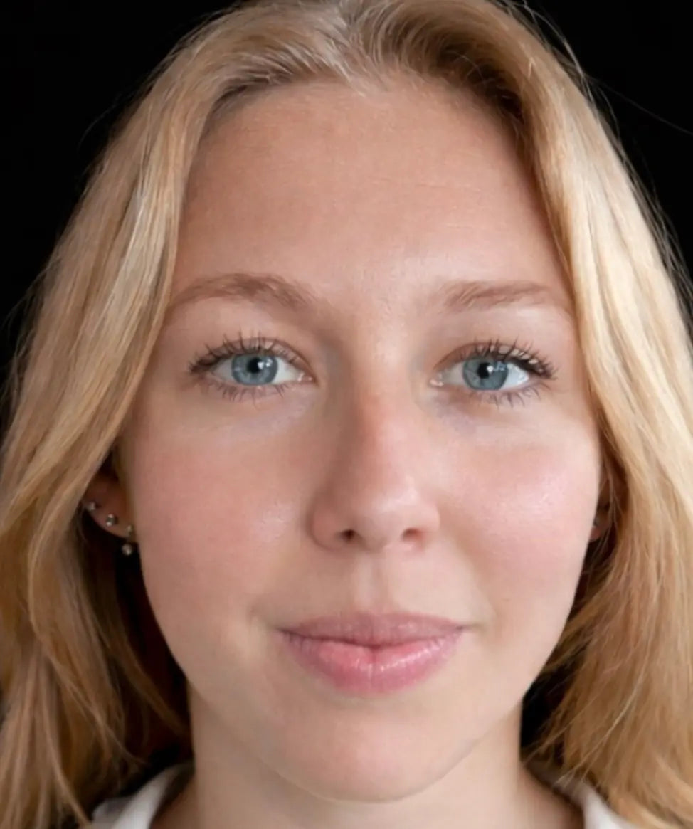 Front view of the same woman after four weeks of Conforma HA once daily, showing smoother, more hydrated-looking skin