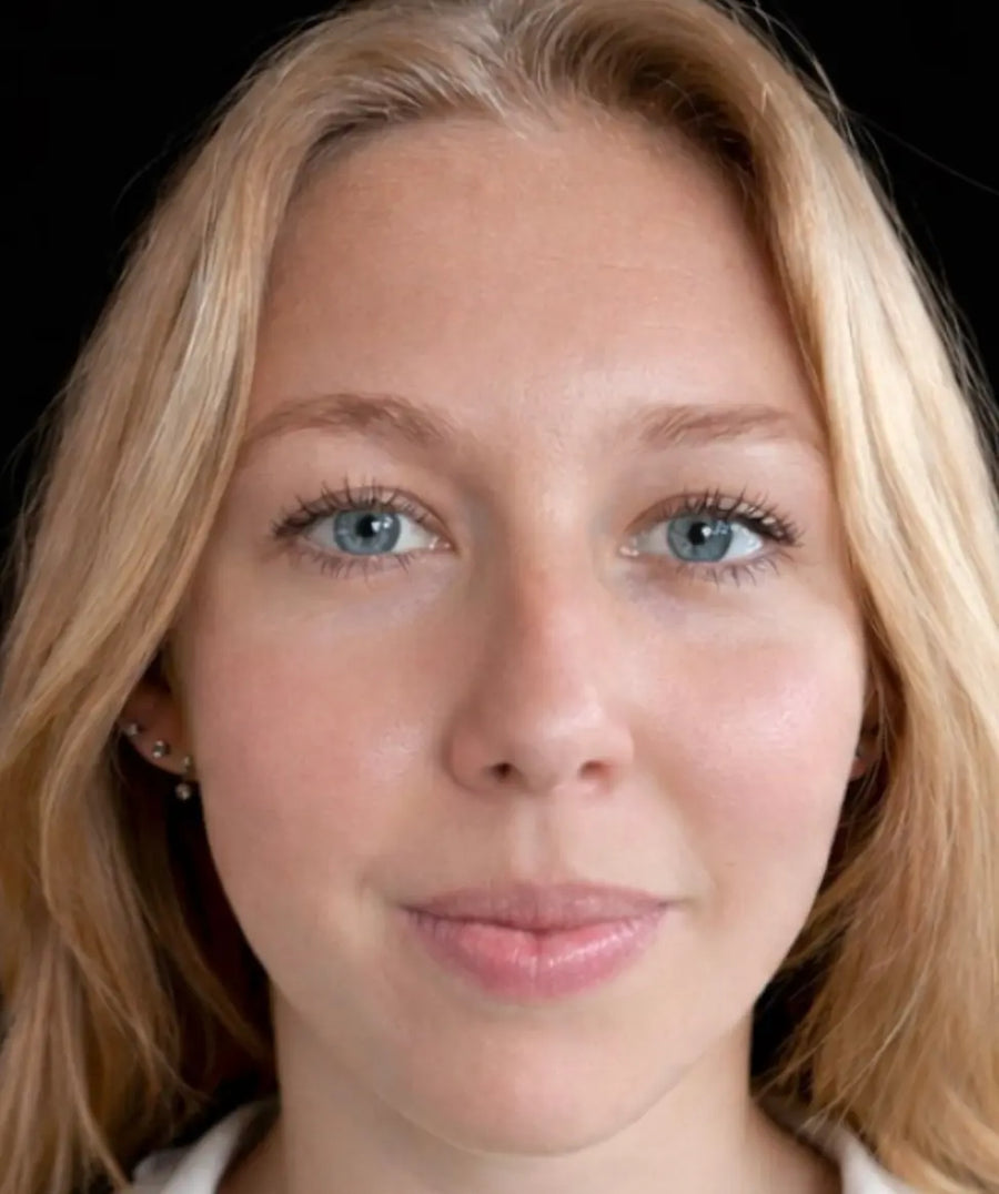 Front view of the same woman after four weeks of Conforma HA once daily, showing smoother, more hydrated-looking skin