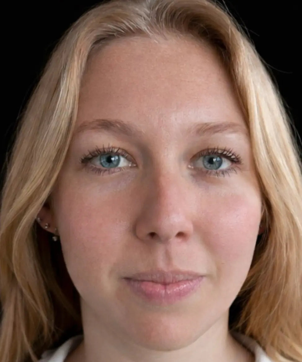 Front view of a woman's face before using Conforma HA, showing uneven skin tone and texture