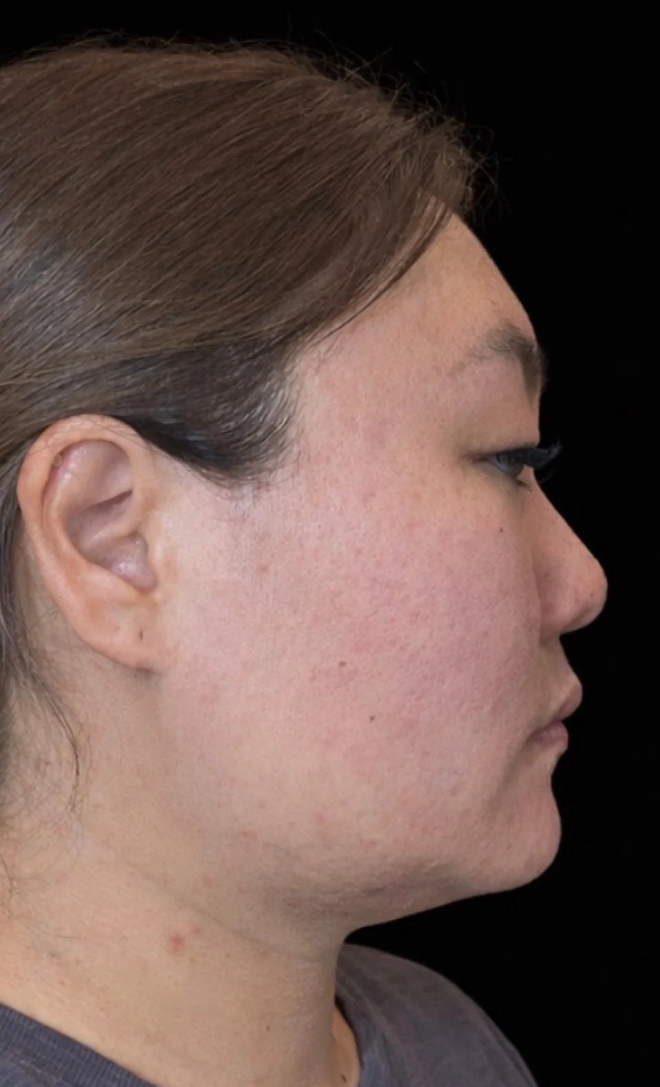 Side profile of a woman before using Conforma Reduce, showing fullness beneath the chin and jawline
