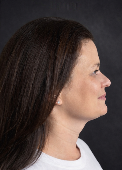 Woman after picture with double chin before using Conforma Reduce.