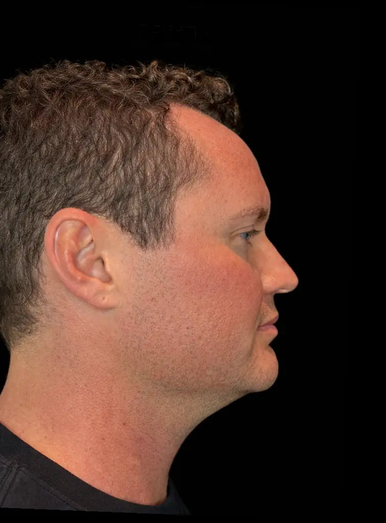 After picture of man with double chin before using Conforma Reduce.