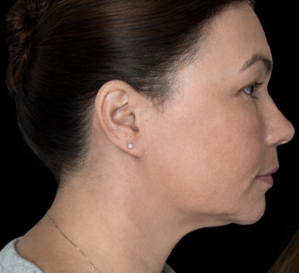 Side profile of the same woman after six weeks of Conforma Reduce, showing a more defined chin and jawline
