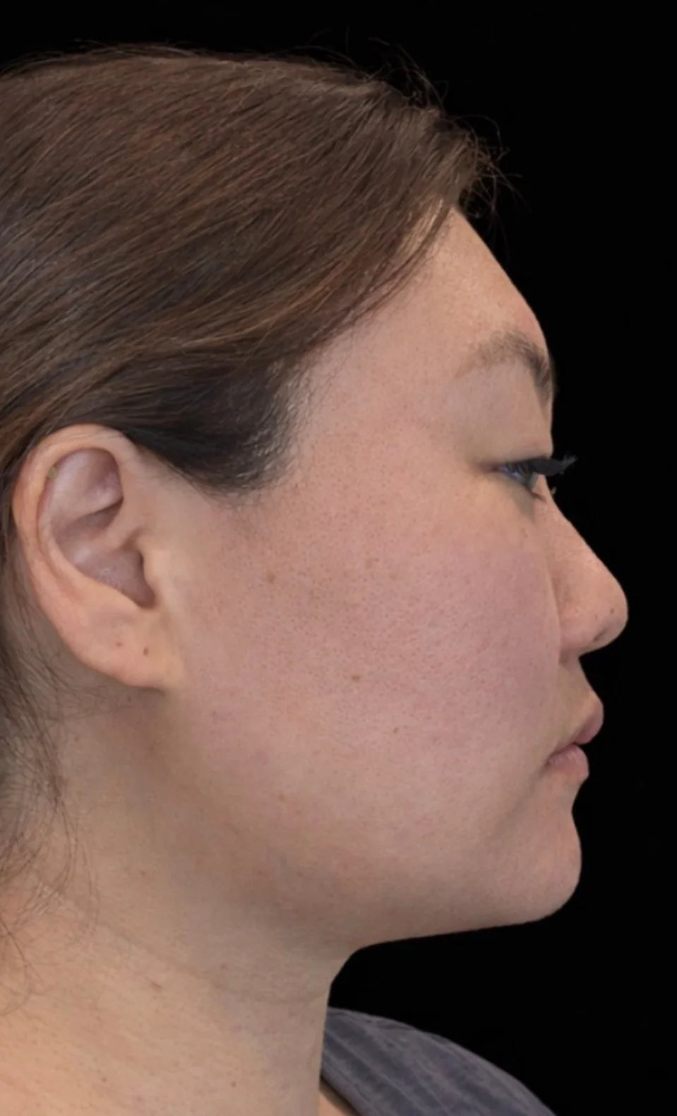 Side profile of the same woman after four weeks of Conforma Reduce, showing a more defined chin and jawline