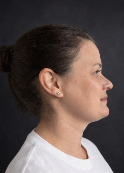 Woman before picture with double chin before using Conforma Reduce.
