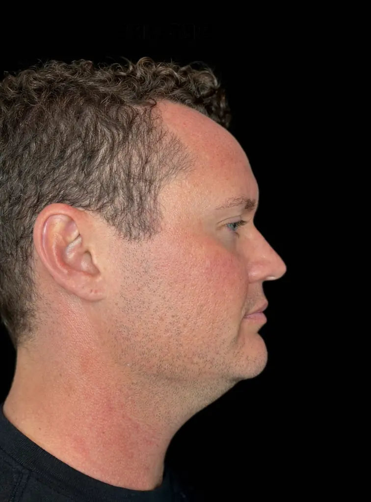 Before picture of man with double chin before using Conforma Reduce.