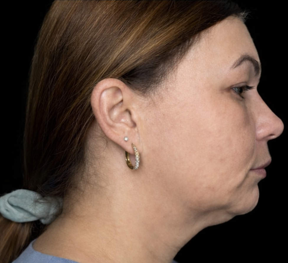 Side profile of a woman before using Conforma Reduce, showing fullness beneath the chin and jawline