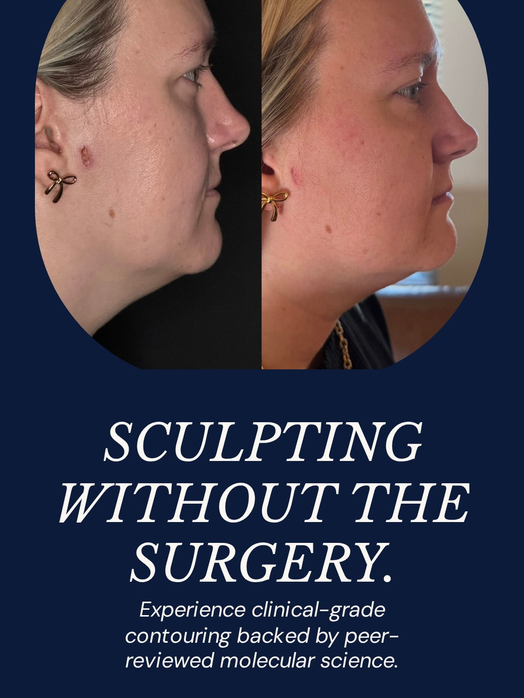 Before-and-after profile photos showing reduced under-chin fullness and a more sculpted jawline, alongside messaging about non-surgical facial contouring.