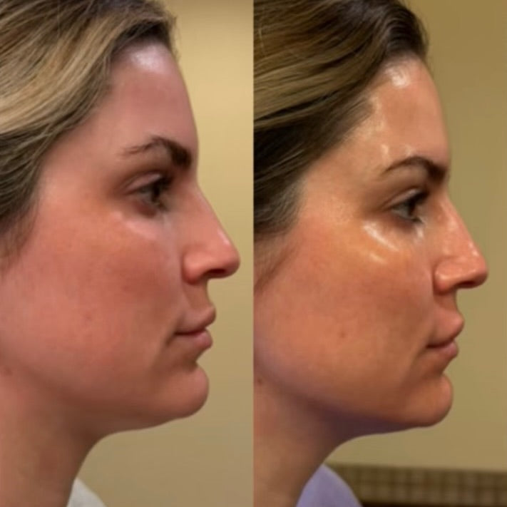 Woman shown, with gold background, before and after Conforma Reduce use, with the after image showing reduced under-chin fullness and a more defined jawline.
